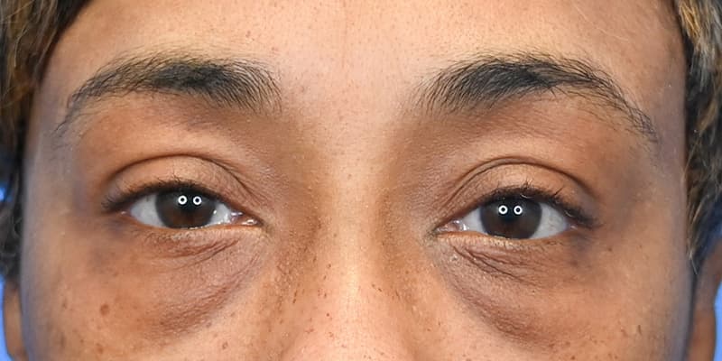 Blepharoplasty Before & After Image