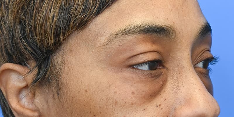 Blepharoplasty Before & After Image