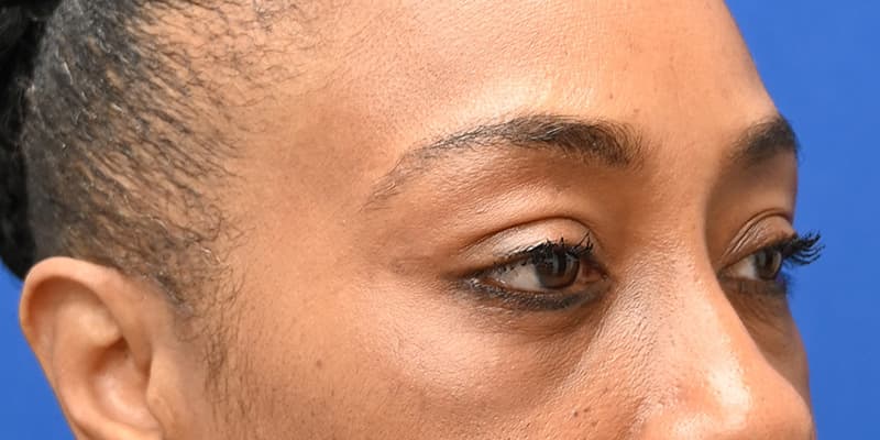 Blepharoplasty Before & After Image