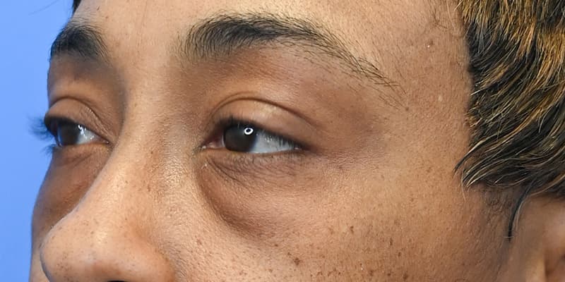 Blepharoplasty Before & After Image