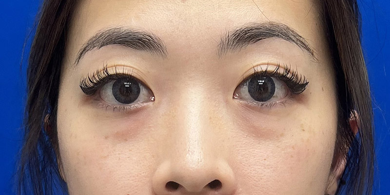 Blepharoplasty Before & After Image