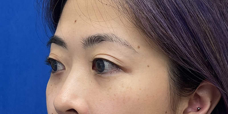 Blepharoplasty Before & After Image