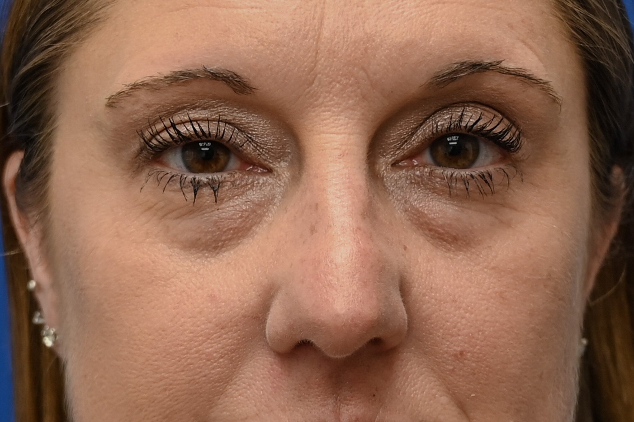 Blepharoplasty Before & After Image