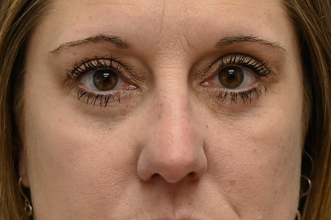 Blepharoplasty Before & After Image