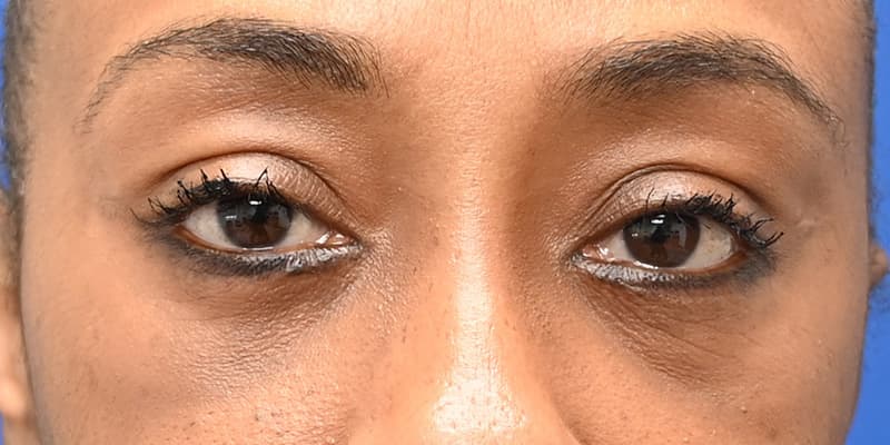 Blepharoplasty Before & After Image