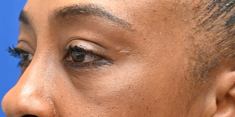 Blepharoplasty Before & After Image