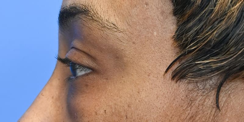 Blepharoplasty Before & After Image