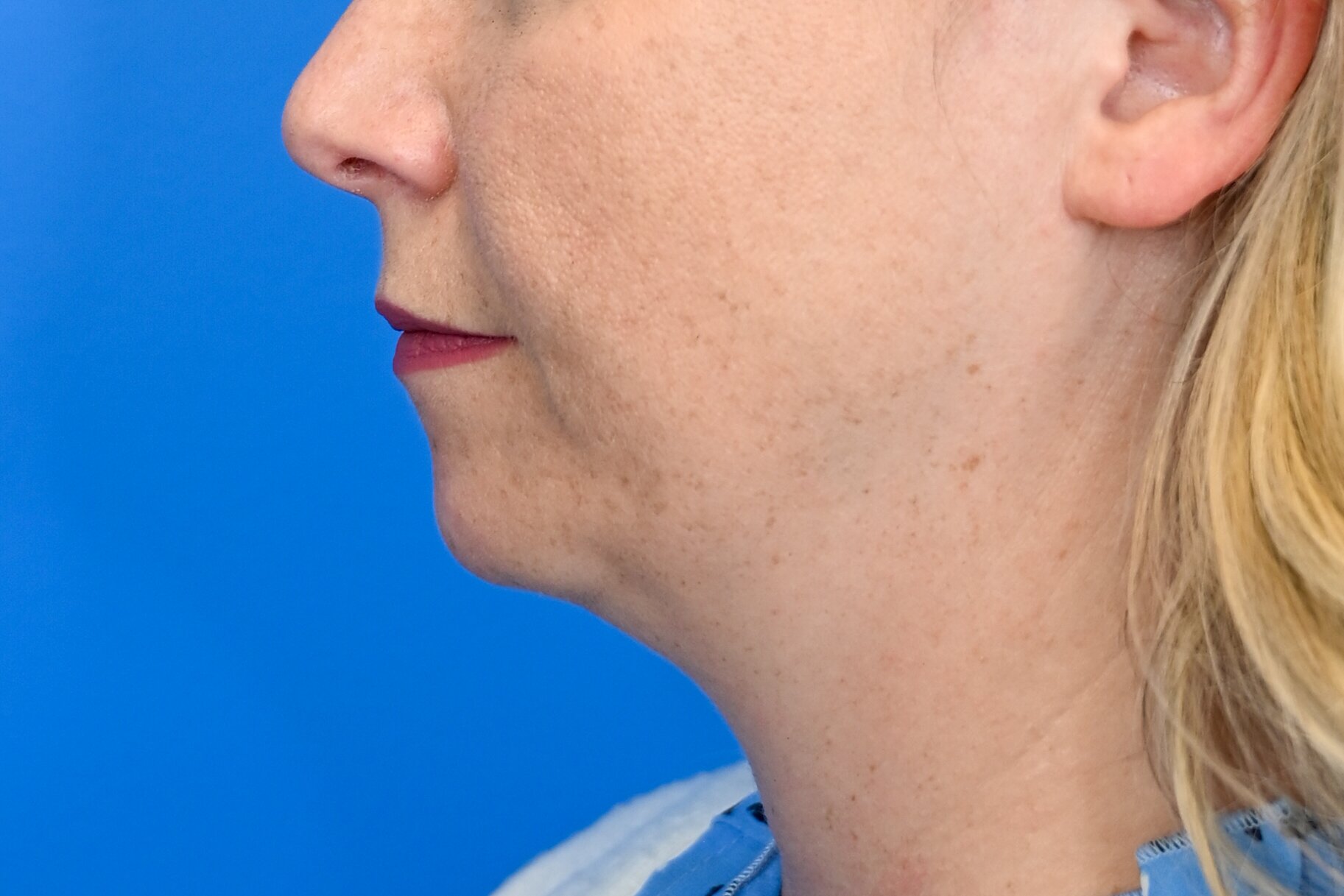 Chin Implants Before & After Image