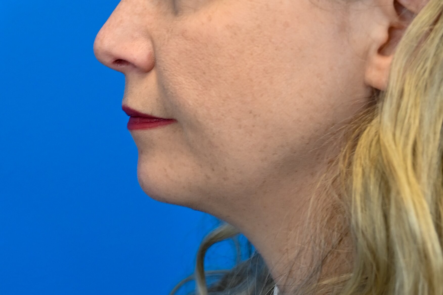 Chin Implants Before & After Image