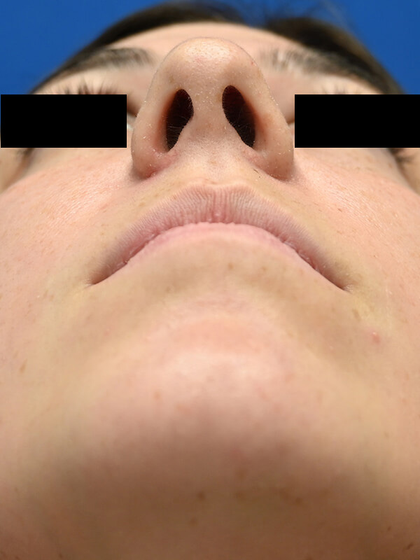 Rhinoplasty Before & After Image