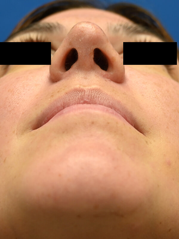 Rhinoplasty Before & After Image