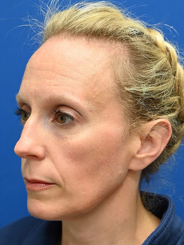 Rhinoplasty Before & After Image