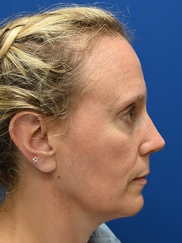 Rhinoplasty Before & After Image