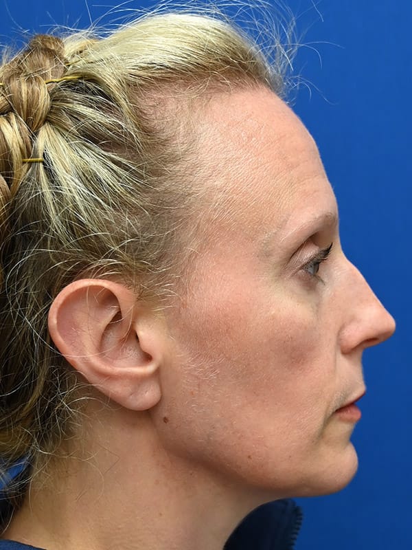 Rhinoplasty Before & After Image