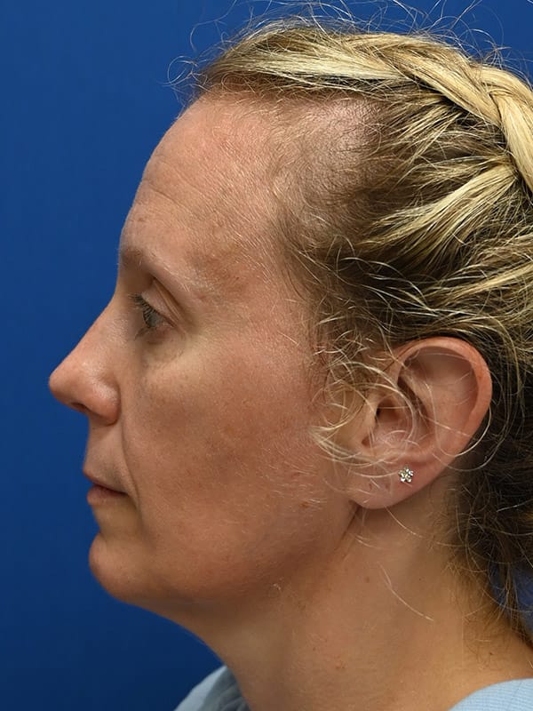 Rhinoplasty Before & After Image