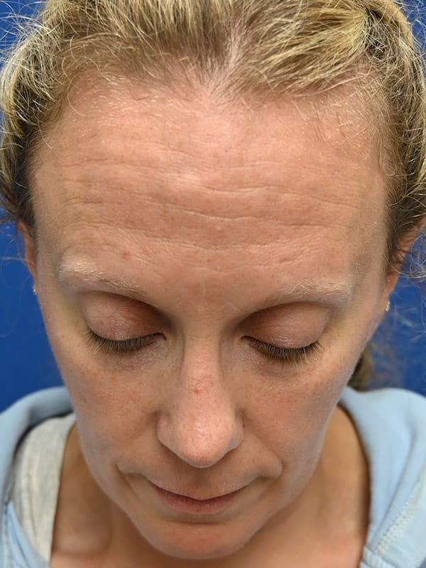 Rhinoplasty Before & After Image