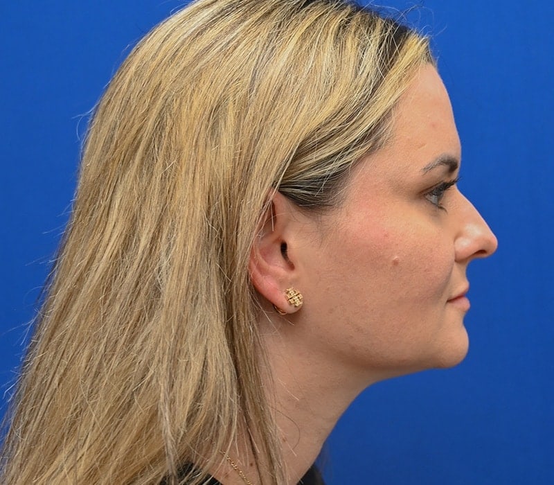 Rhinoplasty Before & After Image